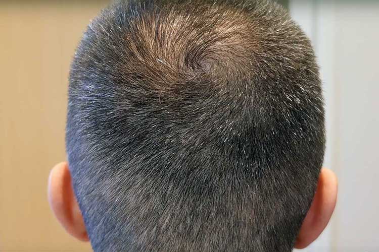 A hajhullás kezelése